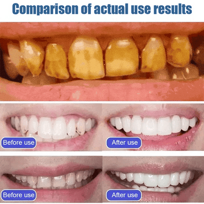 DENTYSIA SP-4 Ultra Whitening Toothpaste Pack of 4 🦷✨